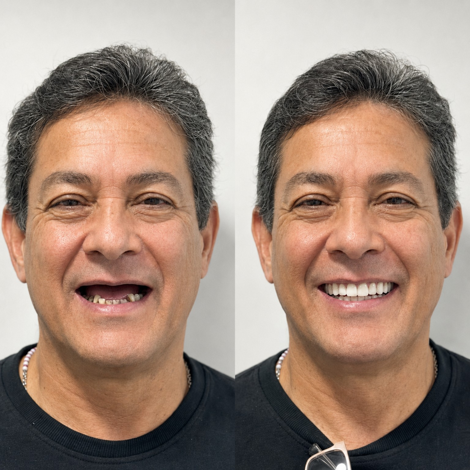 Comparativo de resultado protético antes e depois