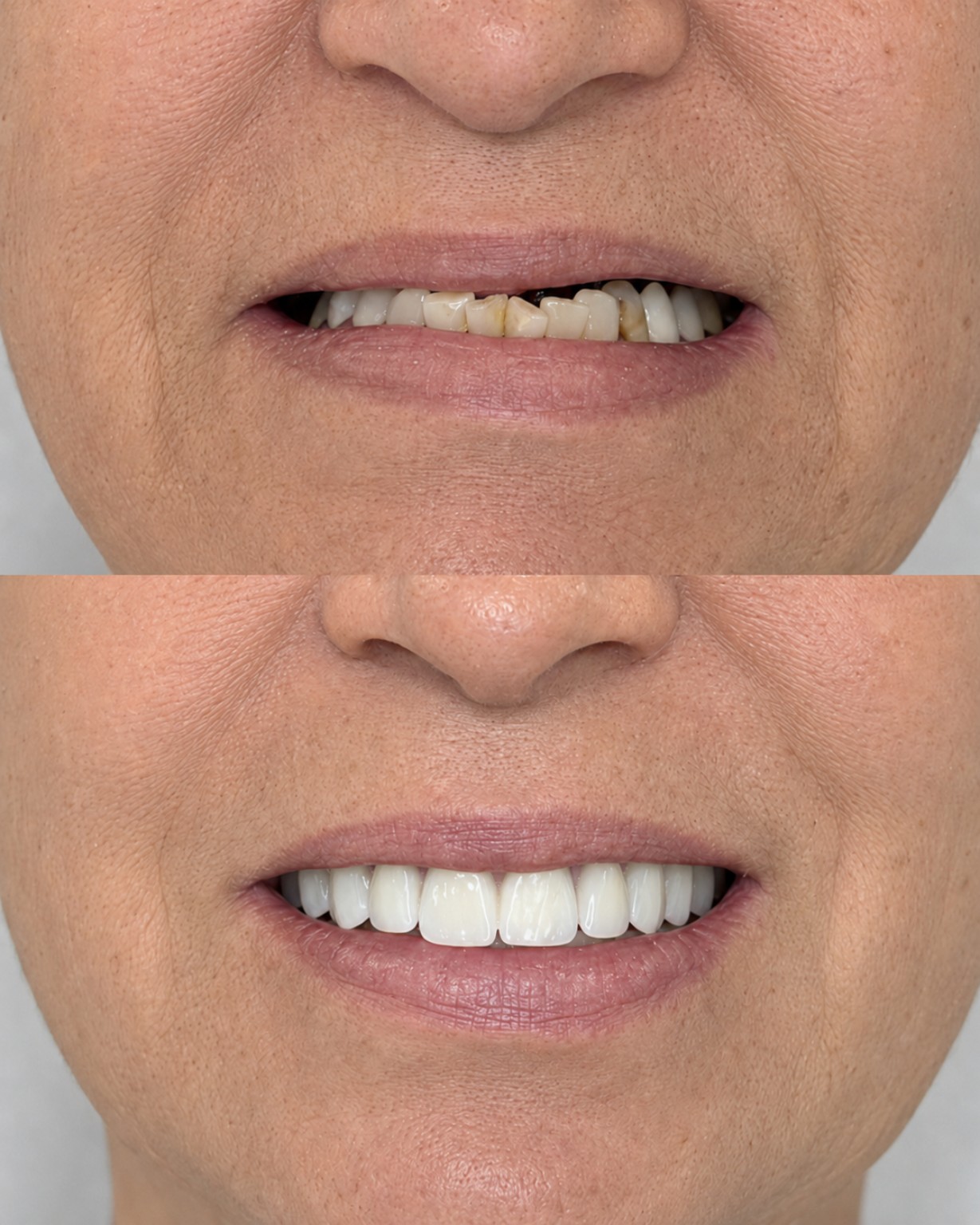 Detalhe do sorriso antes e depois