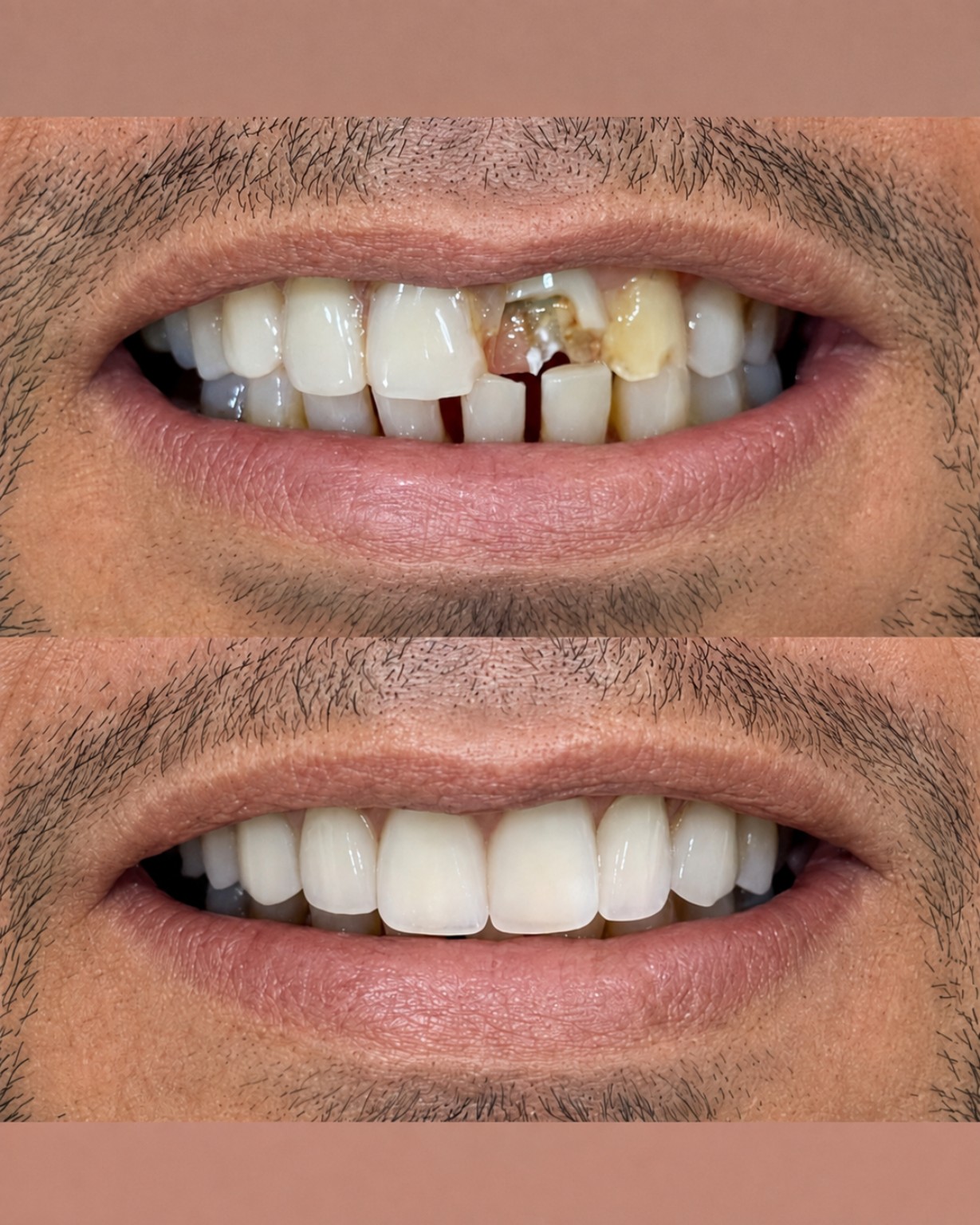 Transformação protética antes e depois